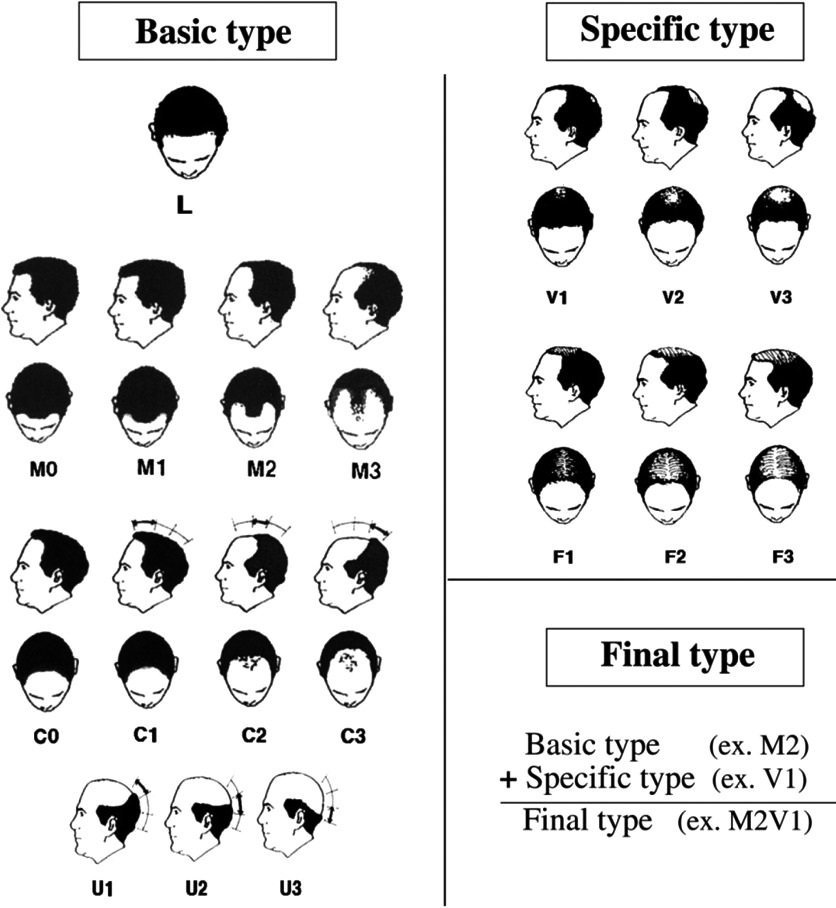 Classification of androgenetic alopecia