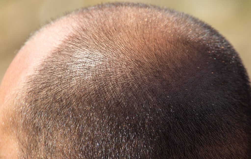 Vitamin B5 and Hair Loss