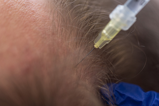 Botox injected into a male's scalp for hair loss