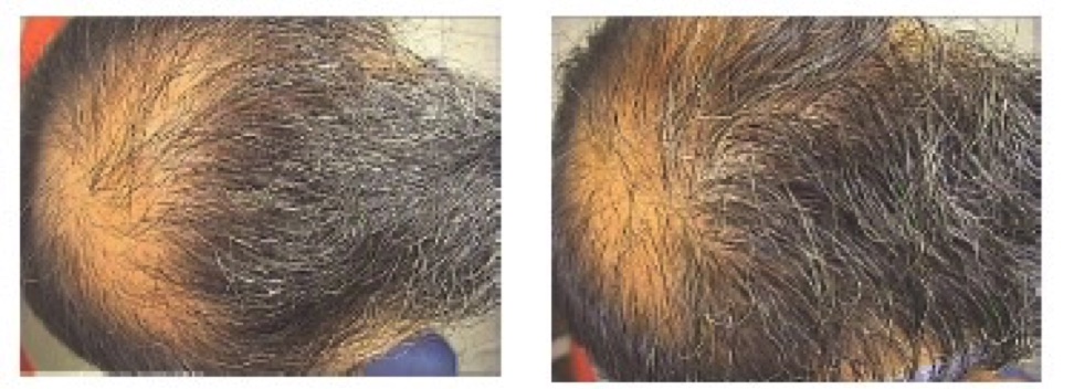 Brotzu for hair loss