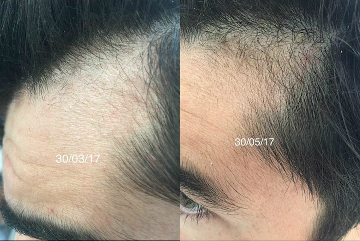 Hair Loss Brotzu lotion