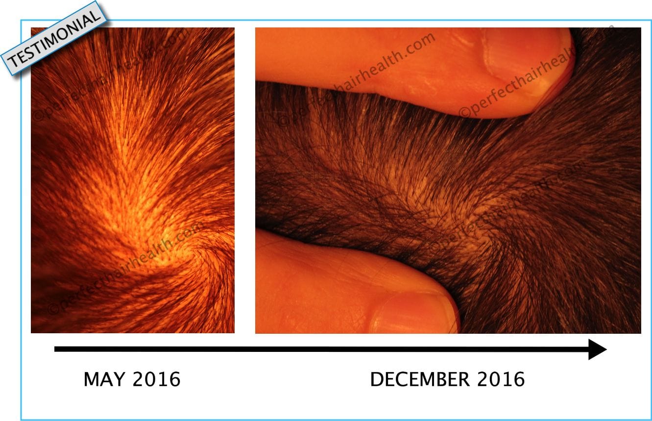 Vertex Hair Regrowth