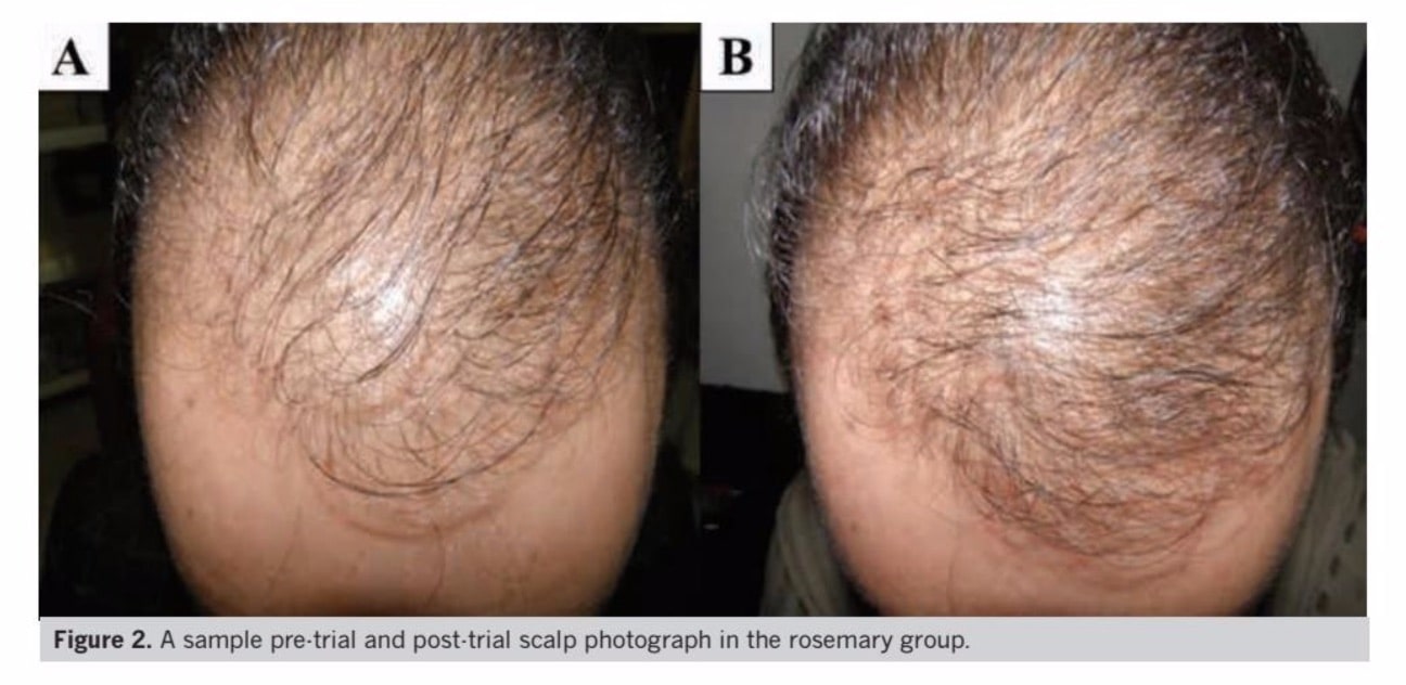 Rosemary Oil Before-After Hair Growth