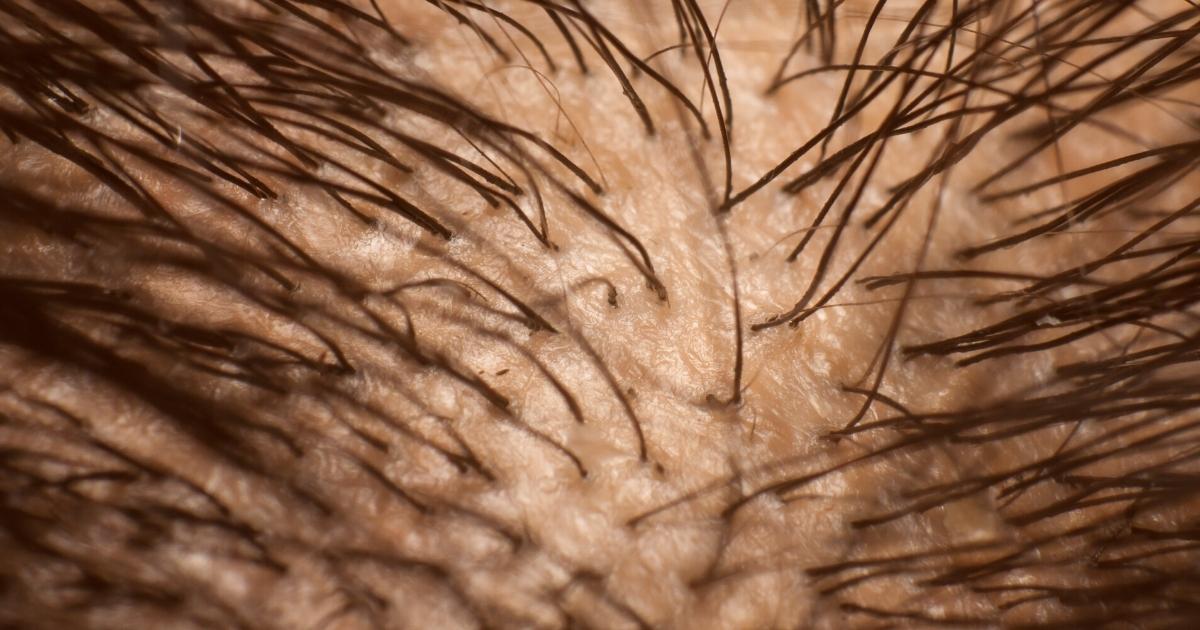 The inflamed scalp of a hair loss sufferer