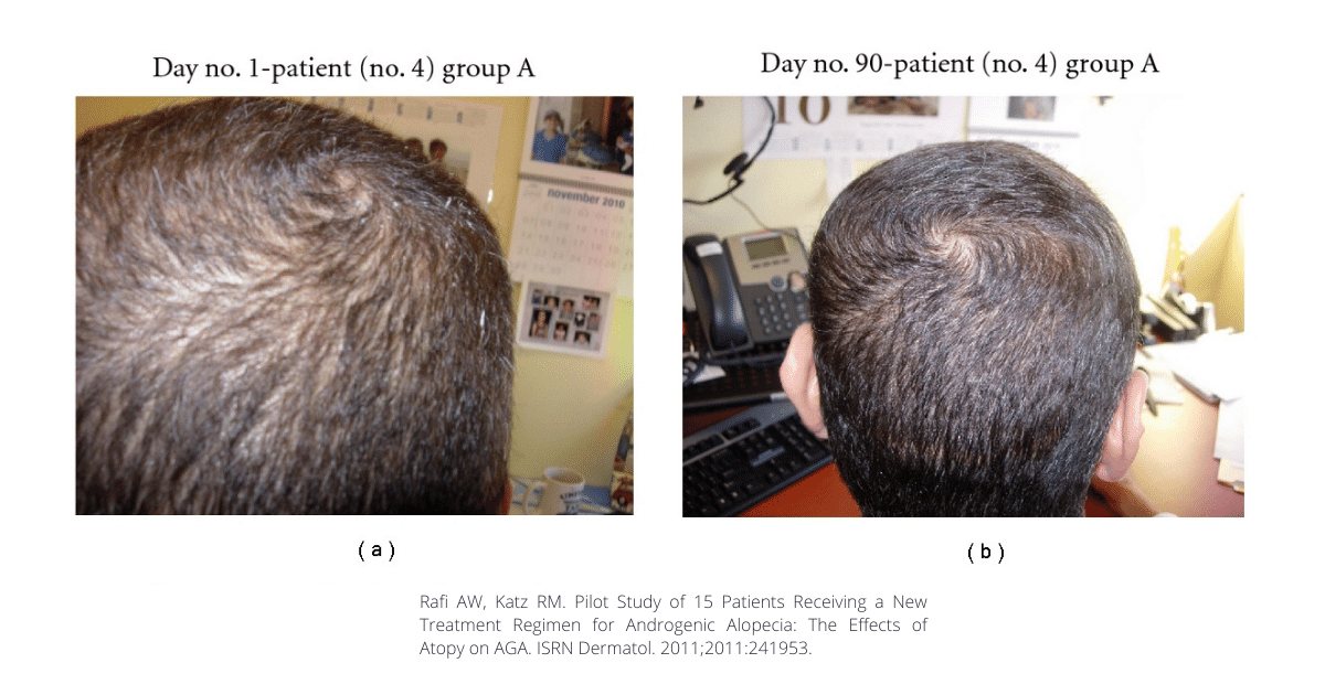 before-and-after-2%-ketoconazole