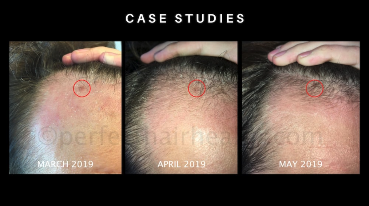 90-day hair growth from ketoconazole