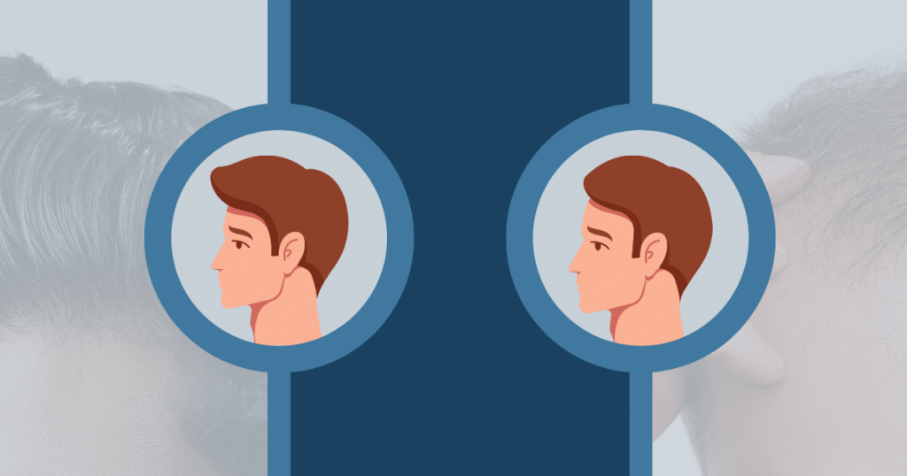 A graphic of the difference between mature vs receding hairline