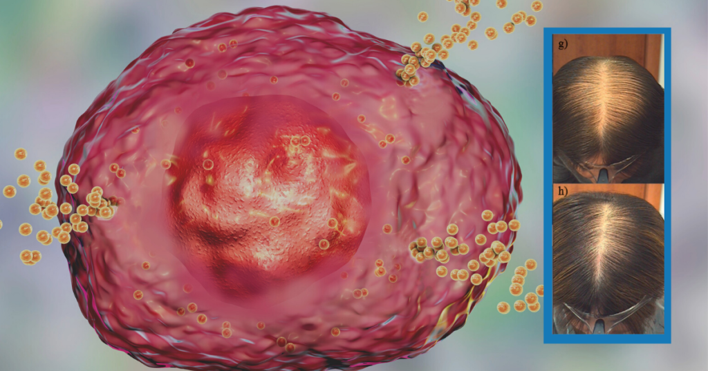 Mast cell releasing histamine during an allergic response, computer illustration