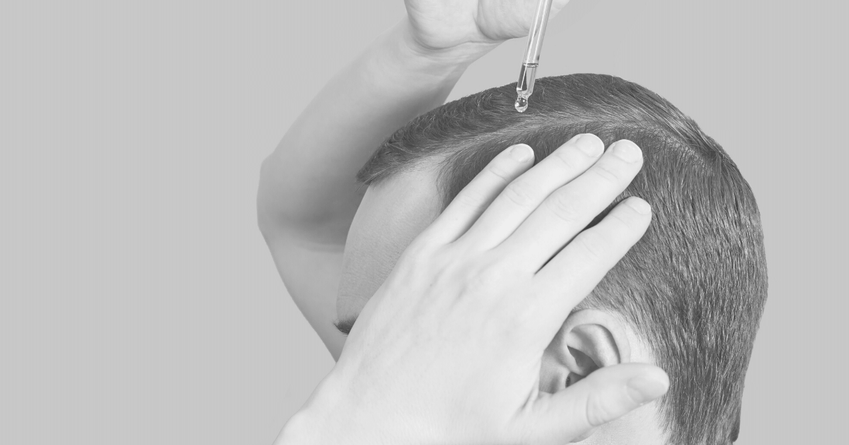 Man applying topical minoxidil for hair loss