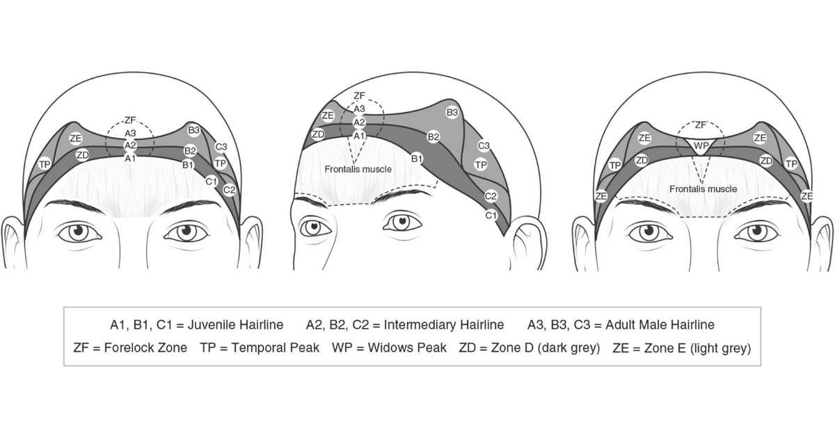 An illustration of a normal hairline