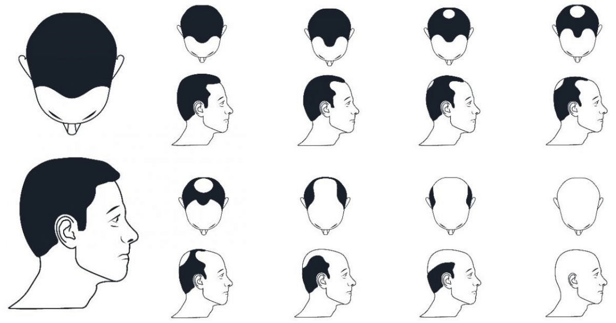 Illustration of the The Norwood-Hamilton scale