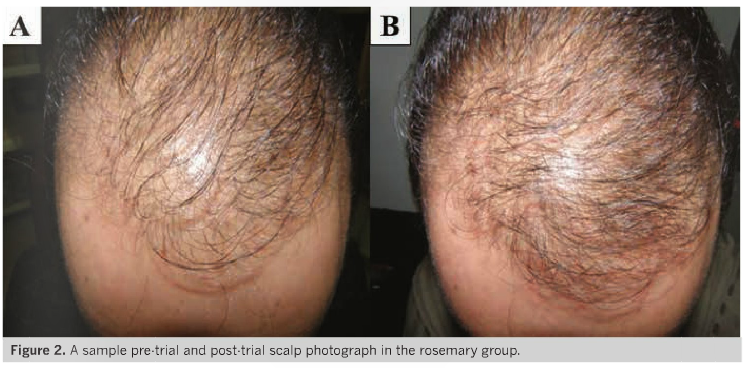 Photo of man hair loss